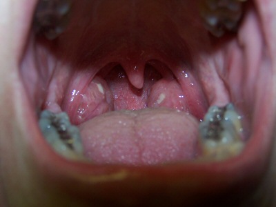 tonsils swollen tonsillitis throat breathe lisa 2007